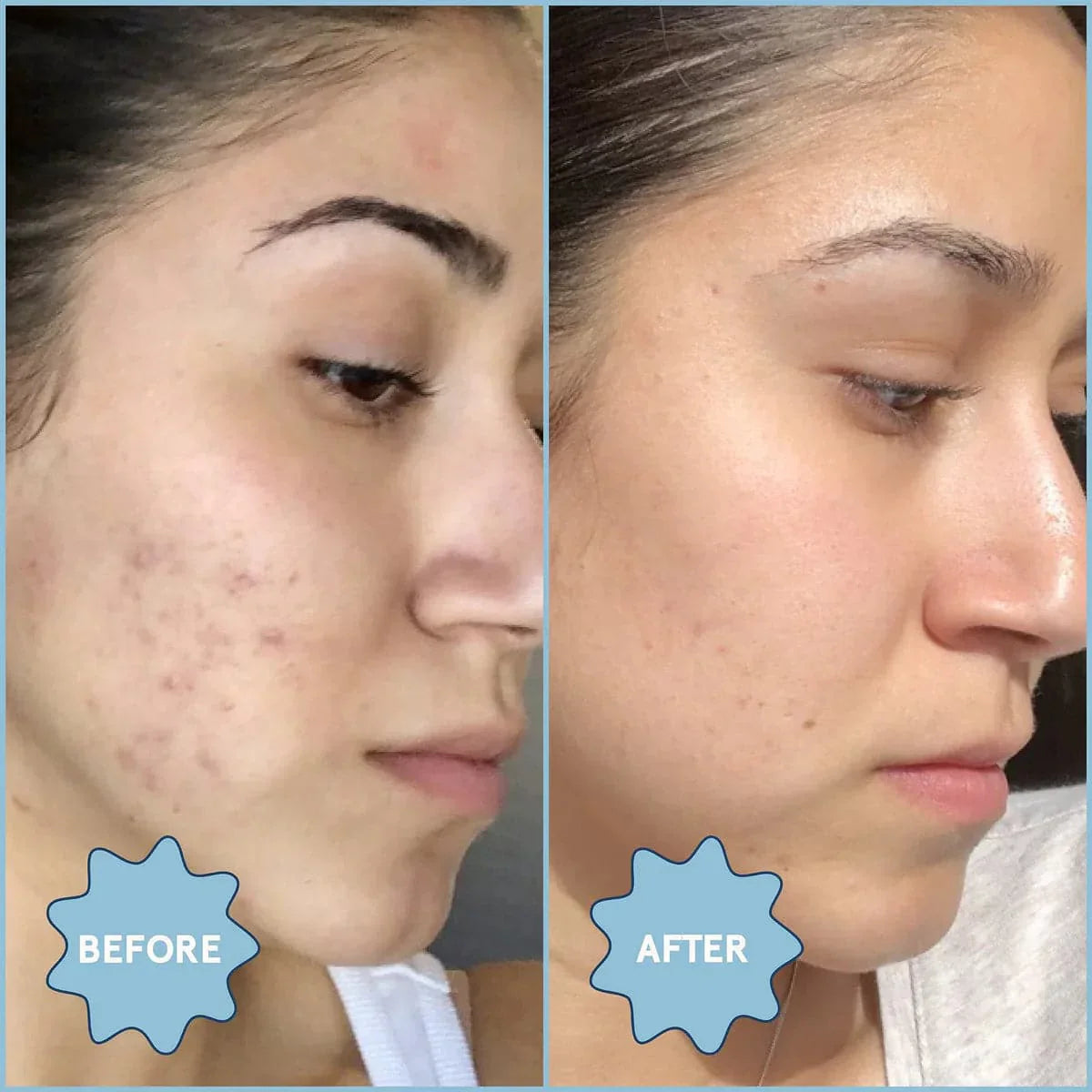 Blume Clear Skin Kit: Acne Essentials Leave Hormonal Acne Behind and Get Clear Skin