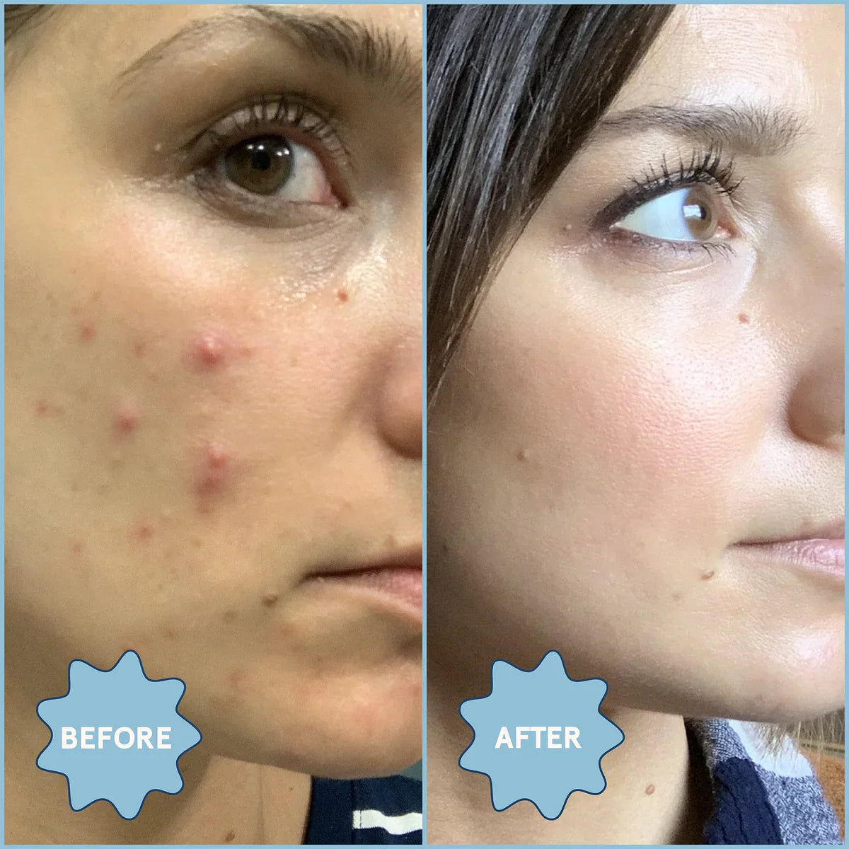 Blume Clear Skin Kit: Acne Essentials Leave Hormonal Acne Behind and Get Clear Skin