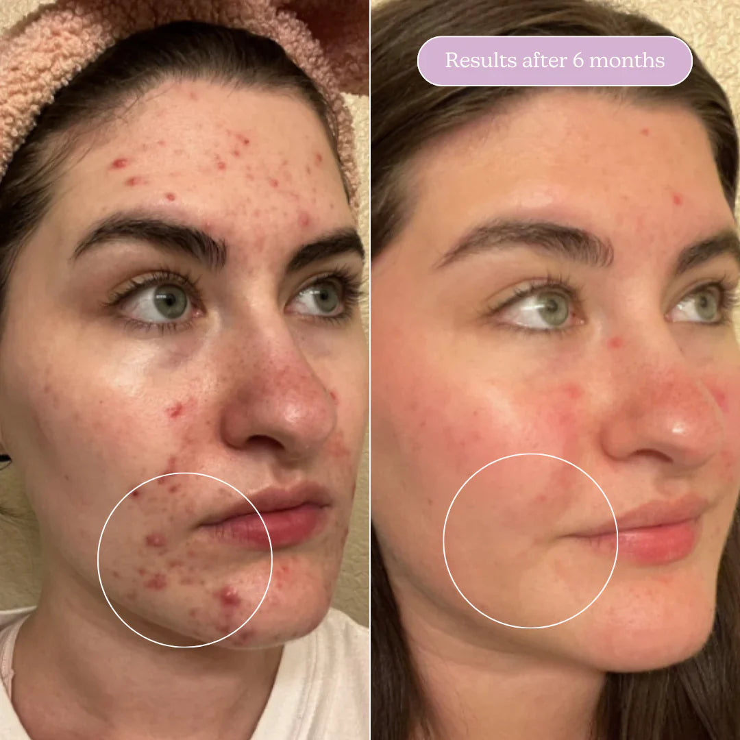 Blume Meltdown Acne Oil